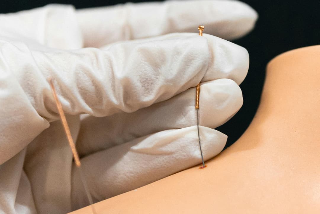 Medical Acupuncture Therapy