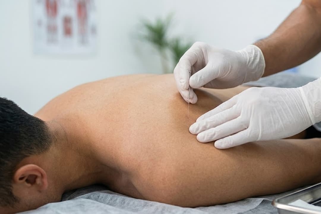 Dry Needling